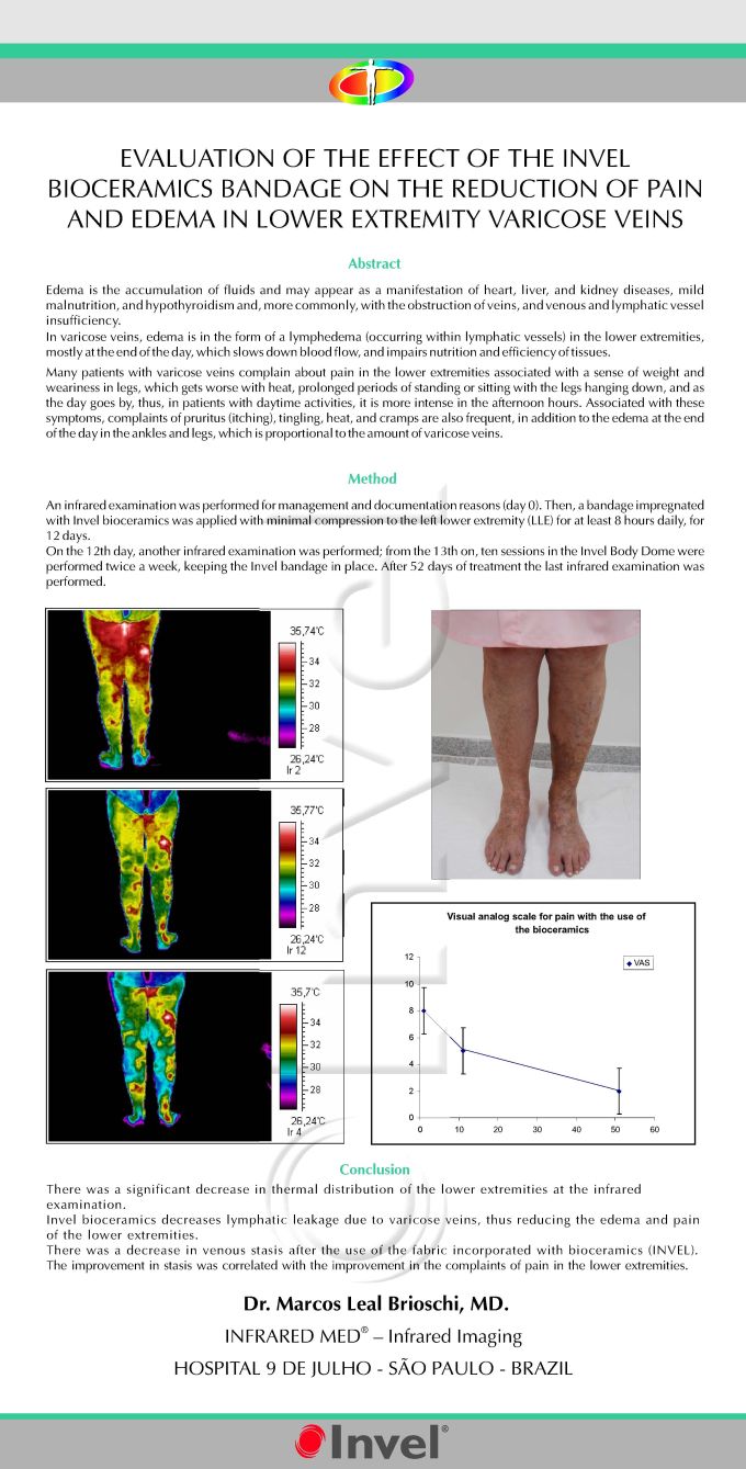 Bioceramic bandage on pain and edema in varicose veins